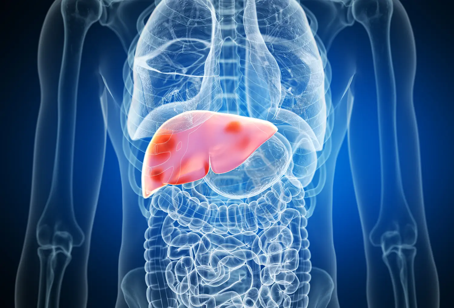 What are MASH and MAFLD?